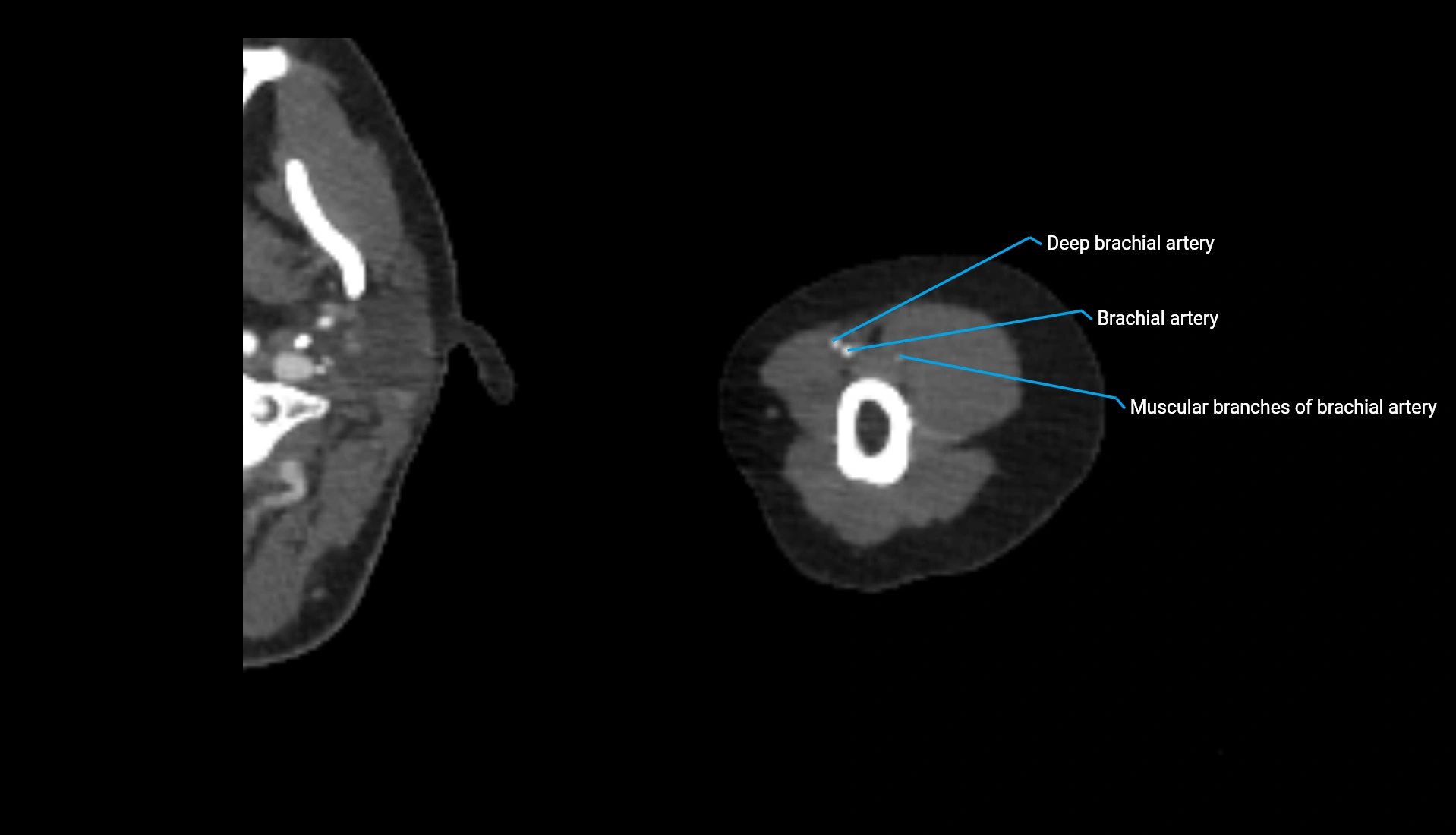 CTA upper limb axial cross sectional anatomy labelled image 277 (2).webp